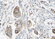 STAT5B Antibody - 1:100 staining human Stomach carcinoma tissue by IHC-P. The tissue was formaldehyde fixed and a heat mediated antigen retrieval step in citrate buffer was performed. The tissue was then blocked and incubated with the antibody for 1.5 hours at 22°C. An HRP conjugated goat anti-rabbit antibody was used as the secondary.