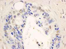 STAT6 Antibody - Detection of Human STAT6 by Immunohistochemistry. Sample: FFPE section of human ovarian carcinoma. Antibody: Affinity purified rabbit anti-STAT6 used at a dilution of 1:1000 (1 ug/ml). Detection: DAB.