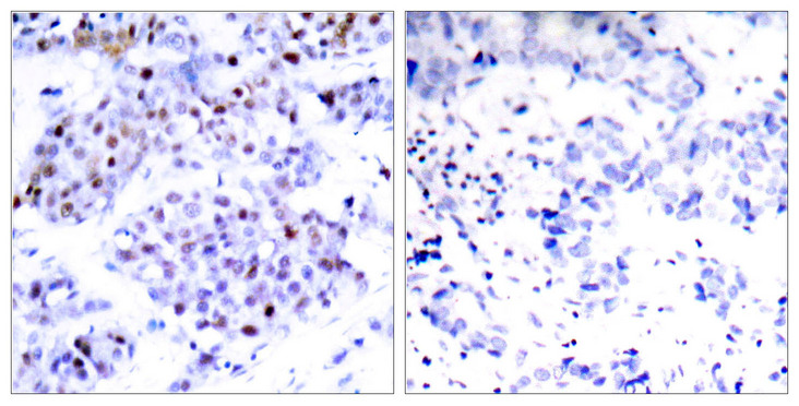 STAT6 Antibody - Immunohistochemistry analysis of paraffin-embedded human breast carcinoma tissue, using STAT6 Antibody. The picture on the right is blocked with the synthesized peptide.