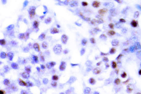 STAT6 Antibody - IHC of STAT6 (R639) pAb in paraffin-embedded human breast carcinoma tissue.