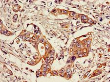 STAT6 Antibody - Immunohistochemistry image of paraffin-embedded human pancreatic cancer at a dilution of 1:100