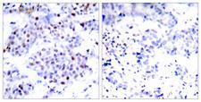 STAT6 Antibody - Peptide - + Immunohistochemical analysis of paraffin-embedded human breast carcinoma tissue using STAT6 (Ab-645) antibody.