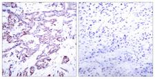 STAT6 Antibody - Immunohistochemistry analysis of paraffin-embedded human breast carcinoma, using STAT6 (Phospho-Thr645) Antibody. The picture on the right is blocked with the phospho peptide.