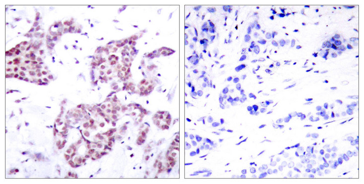 STAT6 Antibody - Immunohistochemistry analysis of paraffin-embedded human breast carcinoma, using STAT6 (Phospho-Tyr641) Antibody. The picture on the right is blocked with the phospho peptide.