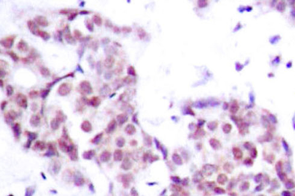 STAT6 Antibody - IHC of p-STAT6 (Y641) pAb in paraffin-embedded human breast carcinoma tissue.