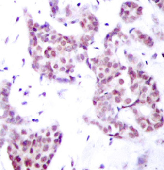 STAT6 Antibody - Immunohistochemical analysis of paraffin-embedded human breast carcinoma tissue.