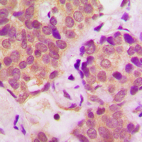 STAT6 Antibody - Immunohistochemical analysis of STAT6 (pY641) staining in human breast cancer formalin fixed paraffin embedded tissue section. The section was pre-treated using heat mediated antigen retrieval with sodium citrate buffer (pH 6.0). The section was then incubated with the antibody at room temperature and detected using an HRP conjugated compact polymer system. DAB was used as the chromogen. The section was then counterstained with hematoxylin and mounted with DPX.