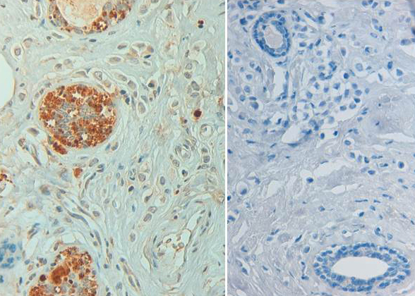 STAT6 Antibody - Immunohistochemistry of rabbit anti STAT6 pY641 Antibody. Tissue: Human breast carcinoma pH 9 (left) with negative control (right).