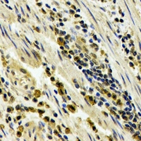 STAU1 / Staufen Antibody - Immunohistochemical analysis of STAU1 staining in human esophageal cancer formalin fixed paraffin embedded tissue section. The section was pre-treated using heat mediated antigen retrieval with sodium citrate buffer (pH 6.0). The section was then incubated with the antibody at room temperature and detected using an HRP conjugated compact polymer system. DAB was used as the chromogen. The section was then counterstained with hematoxylin and mounted with DPX.