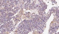 STAU1 / Staufen Antibody - 1:100 staining human lymph carcinoma tissue by IHC-P. The sample was formaldehyde fixed and a heat mediated antigen retrieval step in citrate buffer was performed. The sample was then blocked and incubated with the antibody for 1.5 hours at 22°C. An HRP conjugated goat anti-rabbit antibody was used as the secondary.