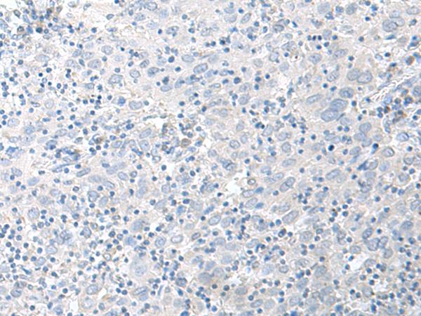 STAU2 Antibody - Immunohistochemistry of paraffin-embedded Human cervical cancer tissue  using STAU2 Polyclonal Antibody at dilution of 1:45(×200)