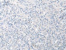 STAU2 Antibody - Immunohistochemistry of paraffin-embedded Human cervical cancer tissue  using STAU2 Polyclonal Antibody at dilution of 1:45(×200)