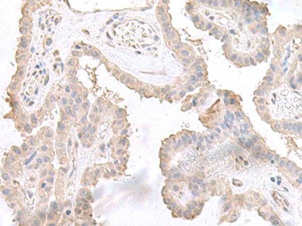 STAU2 Antibody - Immunohistochemistry of paraffin-embedded Human thyroid cancer tissue  using STAU2 Polyclonal Antibody at dilution of 1:45(×200)