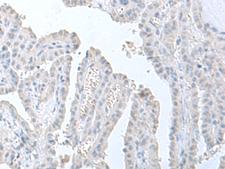 STAU2 Antibody - Immunohistochemistry of paraffin-embedded Human thyroid cancer tissue  using STAU2 Polyclonal Antibody at dilution of 1:60(×200)