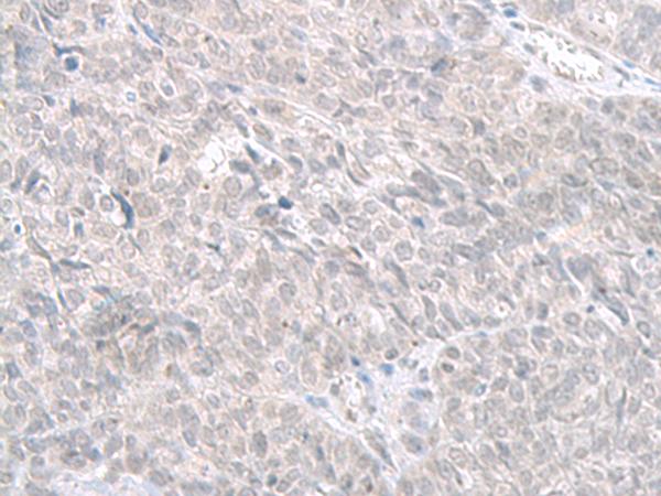 STAU2 Antibody - Immunohistochemistry of paraffin-embedded Human ovarian cancer tissue  using STAU2 Polyclonal Antibody at dilution of 1:60(×200)