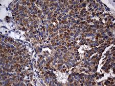 STBD1 Antibody - Immunohistochemical staining of paraffin-embedded Carcinoma of Human pancreas tissue using anti-STBD1 mouse monoclonal antibody. (Heat-induced epitope retrieval by 1mM EDTA in 10mM Tris buffer. (pH8.5) at 120°C for 3 min. (1:2000)