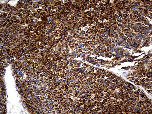 STBD1 Antibody - Immunohistochemical staining of paraffin-embedded Carcinoma of Human liver tissue using anti-STBD1 mouse monoclonal antibody. (Heat-induced epitope retrieval by 1mM EDTA in 10mM Tris buffer. (pH8.5) at 120°C for 3 min. (1:2000)
