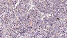STBD1 Antibody - 1:100 staining human lymph carcinoma tissue by IHC-P. The sample was formaldehyde fixed and a heat mediated antigen retrieval step in citrate buffer was performed. The sample was then blocked and incubated with the antibody for 1.5 hours at 22°C. An HRP conjugated goat anti-rabbit antibody was used as the secondary.