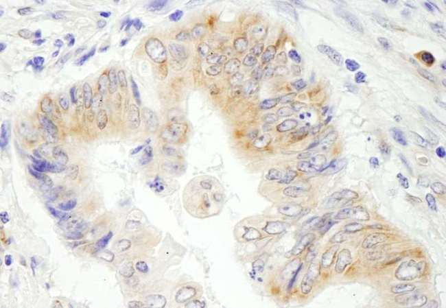STC2 / Stanniocalcin 2 Antibody - Detection of Human Stanniocalcin 2 by Immunohistochemistry. Sample: FFPE section of human colon carcinoma. Antibody: Affinity purified rabbit anti-Stanniocalcin 2 used at a dilution of 1:1000 (1 ug/ml). Detection: DAB.