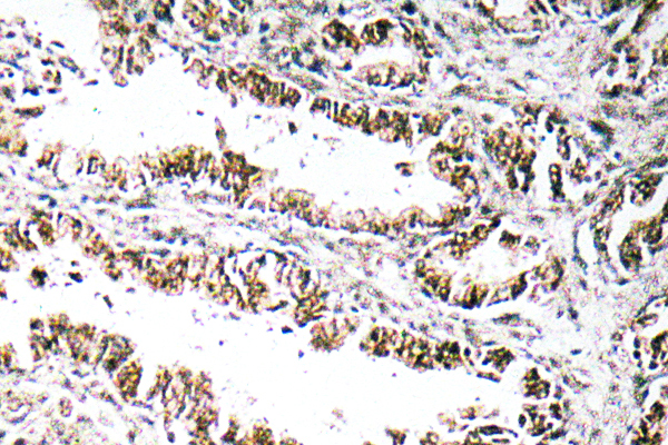 STEAP1 / STEAP Antibody - IHC of STEAP1 (D31) pAb in paraffin-embedded human prostate carcinoma tissue.