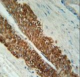 STEAP2 Antibody - STEA2 Antibody immunohistochemistry of formalin-fixed and paraffin-embedded human prostate carcinoma followed by peroxidase-conjugated secondary antibody and DAB staining.