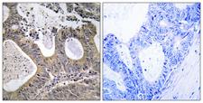 STEAP2 Antibody - Immunohistochemistry analysis of paraffin-embedded human colon carcinoma tissue, using STEA2 Antibody. The picture on the right is blocked with the synthesized peptide.