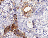 STEAP4 Antibody - 1:100 staining human Prostate carcinoma tissue by IHC-P. The tissue was formaldehyde fixed and a heat mediated antigen retrieval step in citrate buffer was performed. The tissue was then blocked and incubated with the antibody for 1.5 hours at 22°C. An HRP conjugated goat anti-rabbit antibody was used as the secondary.