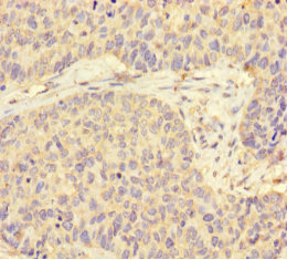 STI1 / STIP1 Antibody - Immunohistochemistry of paraffin-embedded human ovarian cancer using STIP1 Antibody at dilution of 1:100