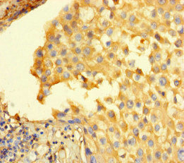 STIL Antibody - Immunohistochemistry of paraffin-embedded human breast cancer at dilution of 1:100