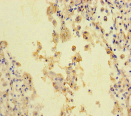 STIL Antibody - Immunohistochemistry of paraffin-embedded human lung cancer at dilution of 1:100