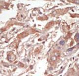 STK10 / LOK Antibody - Formalin-fixed and paraffin-embedded human cancer tissue reacted with the primary antibody, which was peroxidase-conjugated to the secondary antibody, followed by DAB staining. This data demonstrates the use of this antibody for immunohistochemistry; clinical relevance has not been evaluated. BC = breast carcinoma; HC = hepatocarcinoma.
