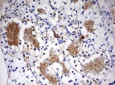 STK11 / LKB1 Antibody - IHC of paraffin-embedded Carcinoma of Human kidney tissue using anti-STK11 mouse monoclonal antibody. (Heat-induced epitope retrieval by 10mM citric buffer, pH6.0, 120°C for 3min).