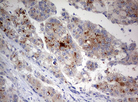 STK11 / LKB1 Antibody - IHC of paraffin-embedded Carcinoma of Human liver tissue using anti-STK11 mouse monoclonal antibody. (Heat-induced epitope retrieval by 10mM citric buffer, pH6.0, 120°C for 3min).