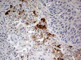 STK11 / LKB1 Antibody - IHC of paraffin-embedded Carcinoma of Human lung tissue using anti-STK11 mouse monoclonal antibody. (Heat-induced epitope retrieval by 10mM citric buffer, pH6.0, 120°C for 3min).