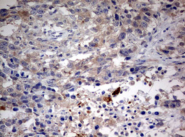 STK11 / LKB1 Antibody - IHC of paraffin-embedded Adenocarcinoma of Human ovary tissue using anti-STK11 mouse monoclonal antibody. (Heat-induced epitope retrieval by 10mM citric buffer, pH6.0, 120°C for 3min).