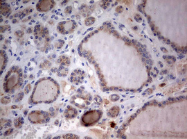 STK11 / LKB1 Antibody - IHC of paraffin-embedded Carcinoma of Human thyroid tissue using anti-STK11 mouse monoclonal antibody. (Heat-induced epitope retrieval by 10mM citric buffer, pH6.0, 120°C for 3min).