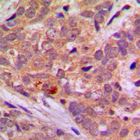 STK11 / LKB1 Antibody - Immunohistochemical analysis of LKB1 staining in human breast cancer formalin fixed paraffin embedded tissue section. The section was pre-treated using heat mediated antigen retrieval with sodium citrate buffer (pH 6.0). The section was then incubated with the antibody at room temperature and detected using an HRP conjugated compact polymer system. DAB was used as the chromogen. The section was then counterstained with hematoxylin and mounted with DPX.