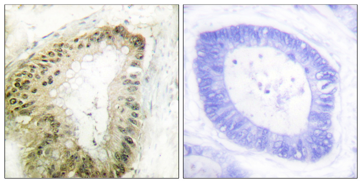 STK11 / LKB1 Antibody - Immunohistochemistry analysis of paraffin-embedded human colon carcinoma, using LKB1 (Phospho-Ser428) Antibody. The picture on the right is blocked with the phospho peptide.