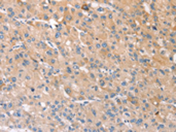STK16 Antibody - Immunohistochemistry of paraffin-embedded Human liver cancer tissue  using STK16 Polyclonal Antibody at dilution of 1:30(×200)