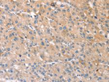 STK16 Antibody - Immunohistochemistry of paraffin-embedded Human liver cancer tissue  using STK16 Polyclonal Antibody at dilution of 1:30(×200)