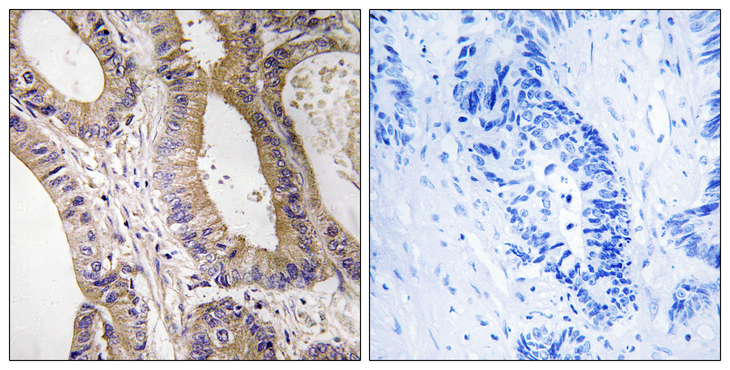 STK24 / MST3 Antibody - Immunohistochemistry analysis of paraffin-embedded human colon carcinoma tissue, using STK24 Antibody. The picture on the right is blocked with the synthesized peptide.