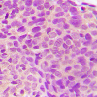 STK24 / MST3 Antibody - Immunohistochemical analysis of MST3 staining in human breast cancer formalin fixed paraffin embedded tissue section. The section was pre-treated using heat mediated antigen retrieval with sodium citrate buffer (pH 6.0). The section was then incubated with the antibody at room temperature and detected using an HRP-conjugated compact polymer system. DAB was used as the chromogen. The section was then counterstained with hematoxylin and mounted with DPX.