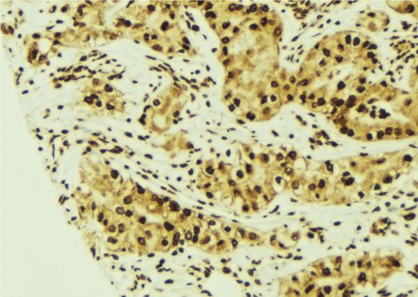 STK24 / MST3 Antibody - 1:100 staining human breast carcinoma tissue by IHC-P. The sample was formaldehyde fixed and a heat mediated antigen retrieval step in citrate buffer was performed. The sample was then blocked and incubated with the antibody for 1.5 hours at 22°C. An HRP conjugated goat anti-rabbit antibody was used as the secondary.
