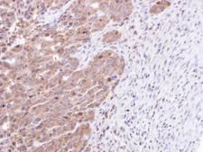 STK25 Antibody - IHC of paraffin-embedded NCIN87 xenograft using STK25 antibody at 1:100 dilution.