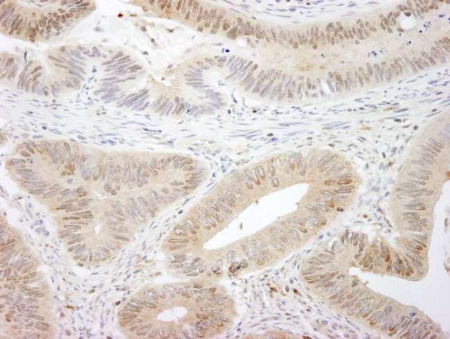 STK3 Antibody - Detection of Human MST1,2/STK3,4 by Immunohistochemistry. Sample: FFPE section of human colon carcinoma. Antibody: Affinity purified rabbit anti-MST1,2/STK3,4 used at a dilution of 1:250.