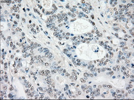 STK3 Antibody - IHC of paraffin-embedded Adenocarcinoma of colon tissue using anti-STK3 mouse monoclonal antibody. (Dilution 1:50).