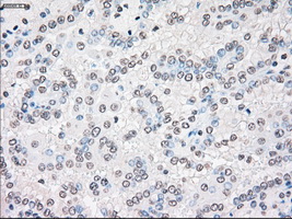 STK3 Antibody - IHC of paraffin-embedded Carcinoma of kidney tissue using anti-STK3 mouse monoclonal antibody. (Dilution 1:50).