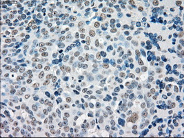 STK3 Antibody - Immunohistochemical staining of paraffin-embedded Adenocarcinoma of ovary tissue using anti-STK3 mouse monoclonal antibody. (Dilution 1:50).