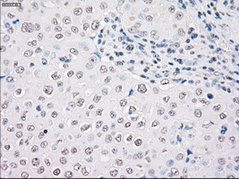 STK3 Antibody - Immunohistochemical staining of paraffin-embedded Adenocarcinoma of breast tissue using anti-STK3 mouse monoclonal antibody. (Dilution 1:50).