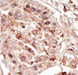 STK31 Antibody - Formalin-fixed and paraffin-embedded human cancer tissue reacted with the primary antibody, which was peroxidase-conjugated to the secondary antibody, followed by DAB staining. This data demonstrates the use of this antibody for immunohistochemistry; clinical relevance has not been evaluated. BC = breast carcinoma; HC = hepatocarcinoma.